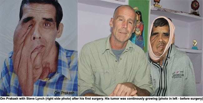 Facial Tumor of Om Prakash Removed successfully