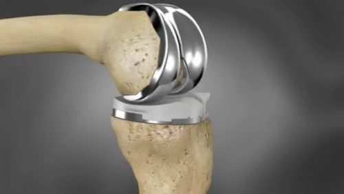 6 hospitals in Udaipur issued notice over knee implant rates