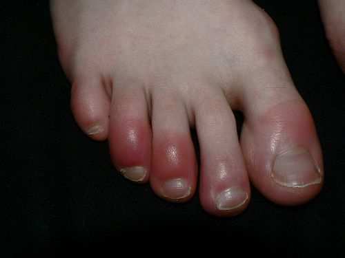Troubled with swollen fingers and toes in winters?