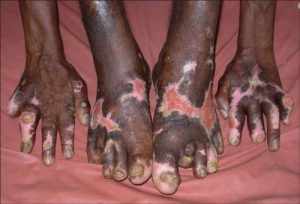 Leprosy is not contagious-Collector creates awareness