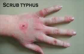 Scrub Typhus infection-Attack of parasite Tsutsugamushi