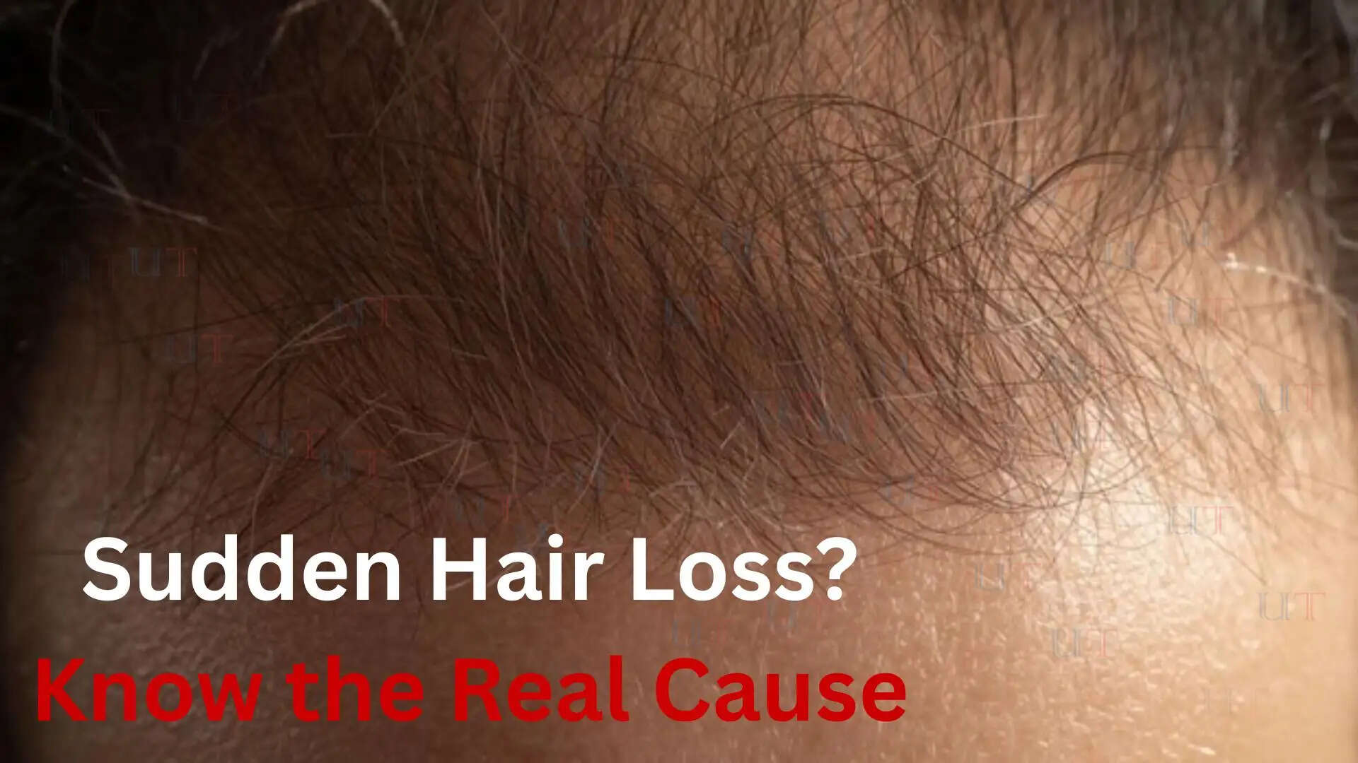 Woman experiencing sudden hair loss due to telogen effluvium condition