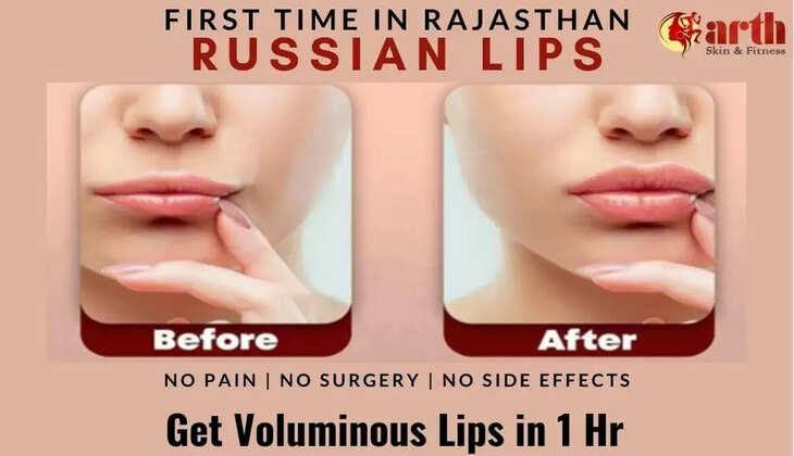 Arth Skin Udaipur Beautiful Lips Russian Lips Technique in Udaipur Skin Treatment in Udaipur Cosmetic Surgery in udaipur, Russian Lips, Lip Filler, Lip Augmentation, Lip Beauty, Dr Arvinder Singh, Arth Skin and Fitness