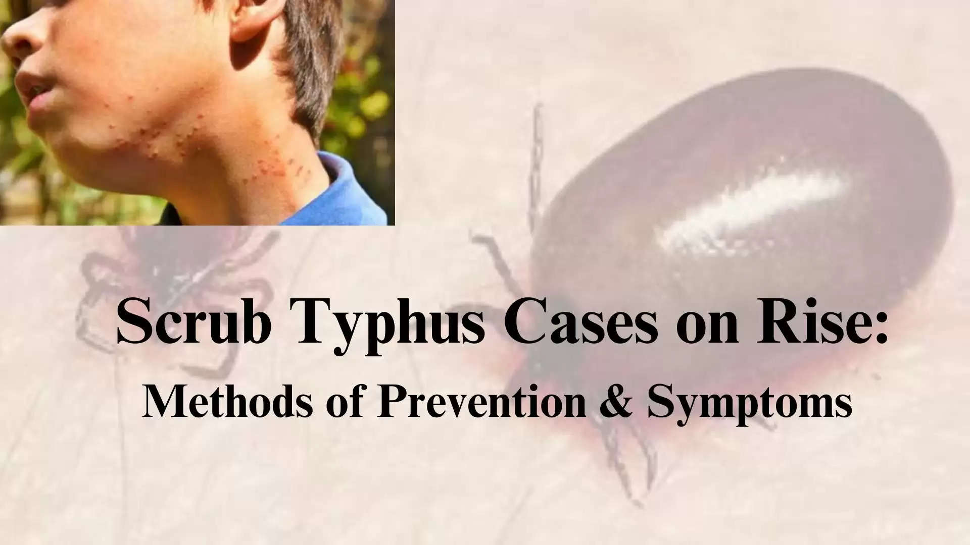 Scrub Typhus