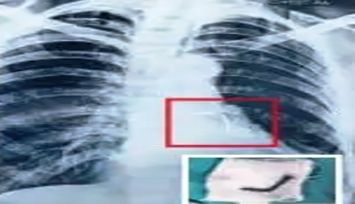 Nail taken out from woman's trachea (wind pipe)