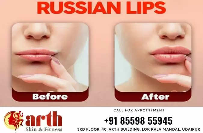 Arth Skin Udaipur Beautiful Lips Russian Lips Technique in Udaipur Skin Treatment in Udaipur Cosmetic Surgery in udaipur, Russian Lips, Lip Filler, Lip Augmentation, Lip Beauty, Dr Arvinder Singh, Arth Skin and Fitness