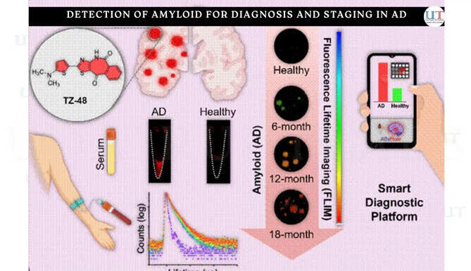 New Smart Technology Can Make Diagnosis of AD More Accessible