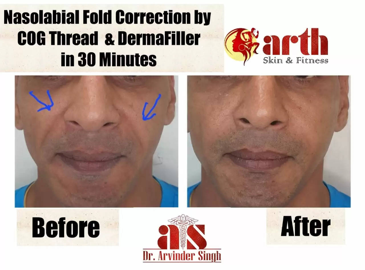 DEFY THE SIGN OF AGING WITH NON SURGICAL FACE LIFT BY FDA APPROVED THREAD LIFT – DR. ARVINDER SINGH, arth skin and fitness