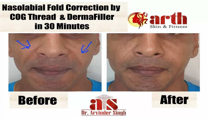 DEFY THE SIGN OF AGING WITH NON SURGICAL FACE LIFT BY FDA APPROVED THREAD LIFT &ndash; DR. ARVINDER SINGH, arth skin and fitness
