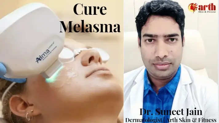 Melasma Cure for Skin Pigmentation Arth Skin and Fitness udaipur Dr Arvinder Singh Dr Suneet Jain Dermatologist