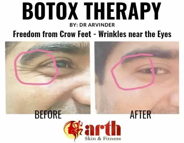 Botox Therapy Skin Treatment at Udaipur Wrinkle Treatment at Udaipur Best Cosmetic Therapy at Udaipur
