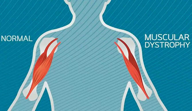 muscular Dystogrophy