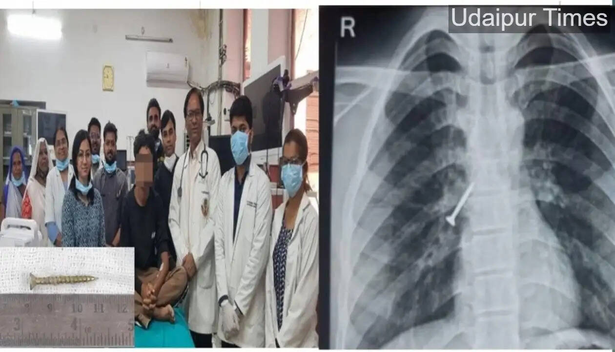 Alt Text: Doctors at RNT Medical College Udaipur remove 32mm screw from teen&rsquo;s airway using flexible bronchoscopy
