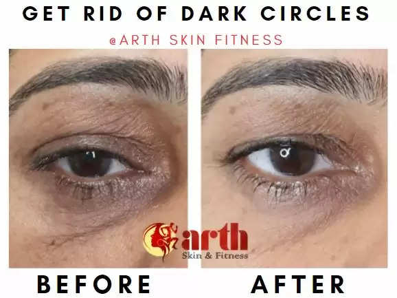 remove dark circles from under eyes at arth skin fitness udaipur arvinder skin clinic at udaipur
